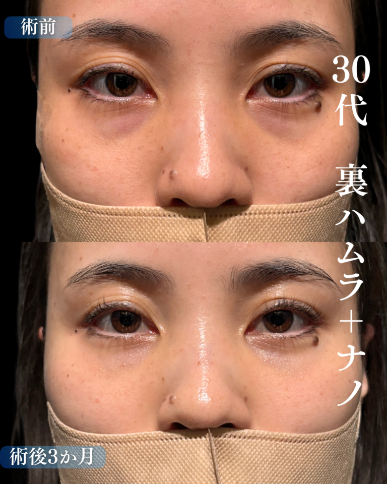 30代女性　裏ハムラ法+脂肪注入
